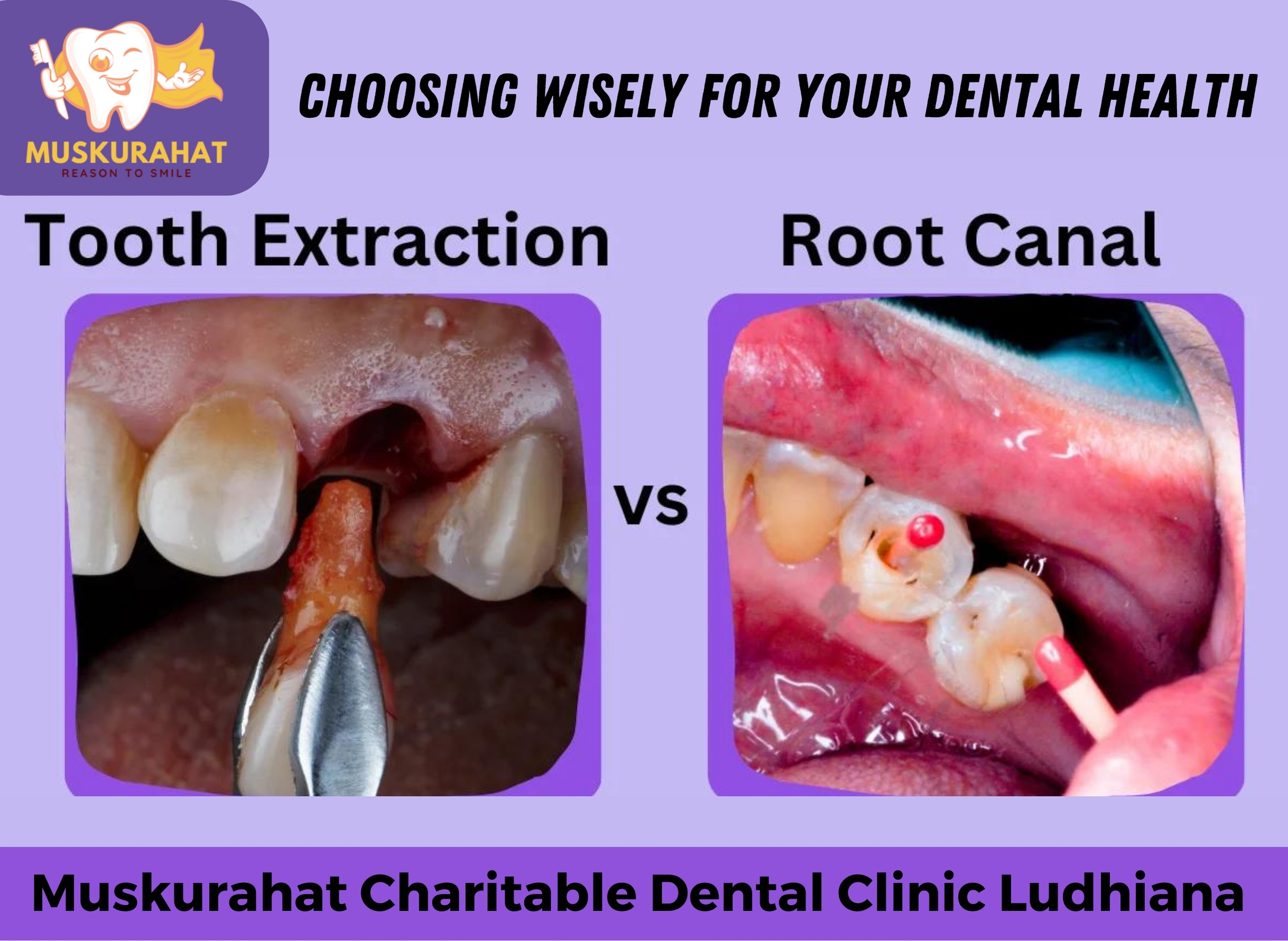 Root Canal vs. Tooth Extraction: Choosing Wisely for Your Dental Health