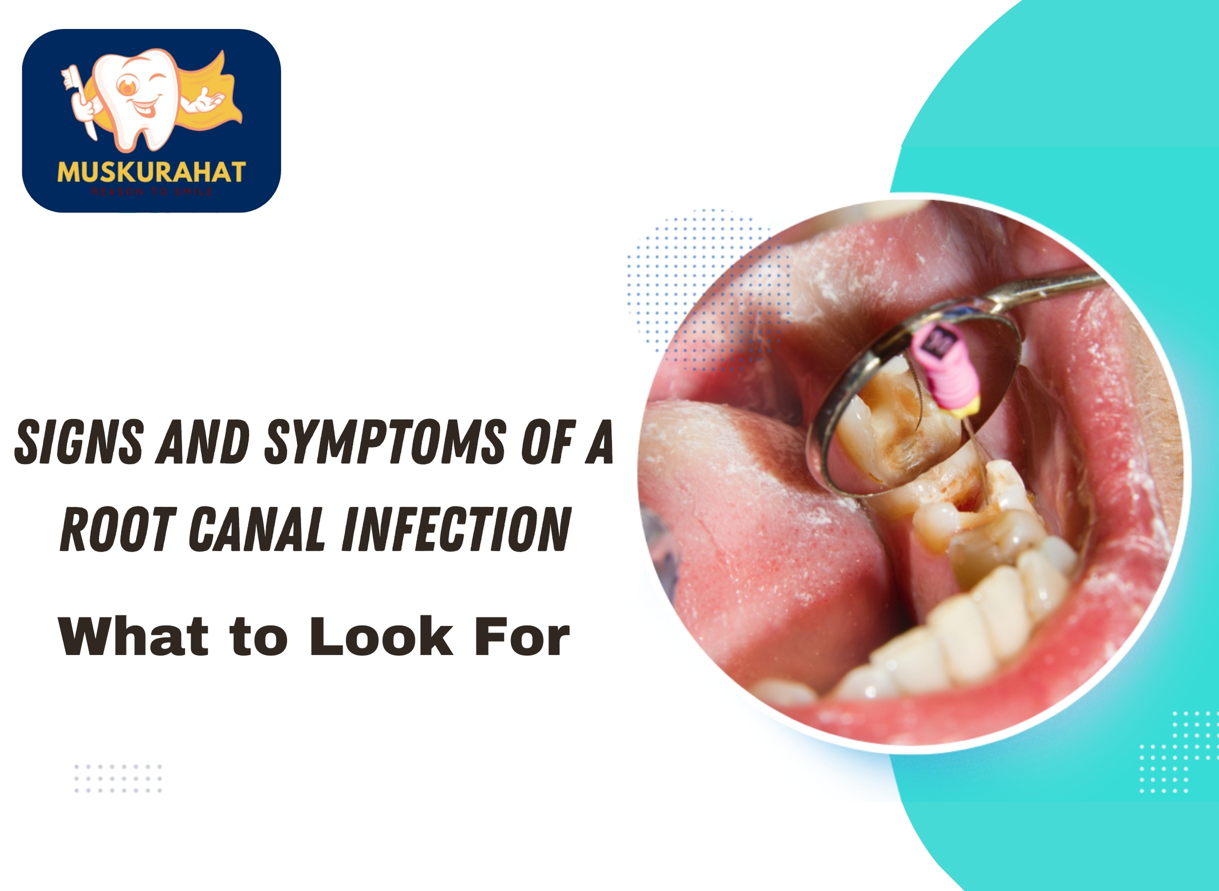 Signs and Symptoms of a Root Canal Infection: What to Look For